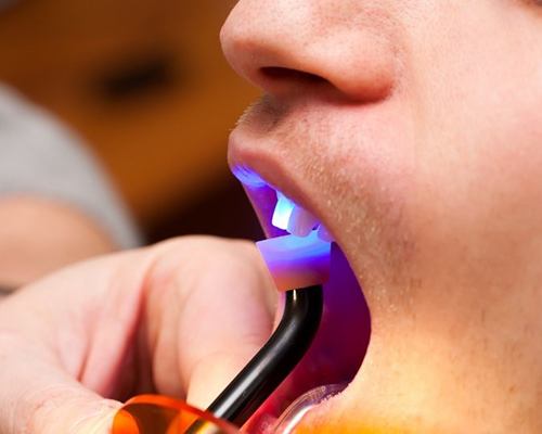curing light being used to harden dental bonding in Center