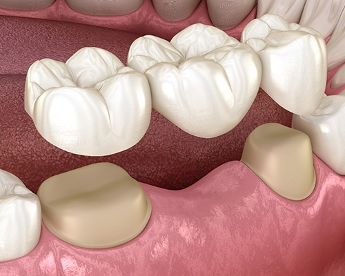 Diagram of a dental bridge in Center being placed