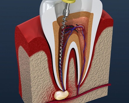 3D diagram of a root canal