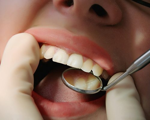 Closeup of patient during dental checkup with Center dentist 