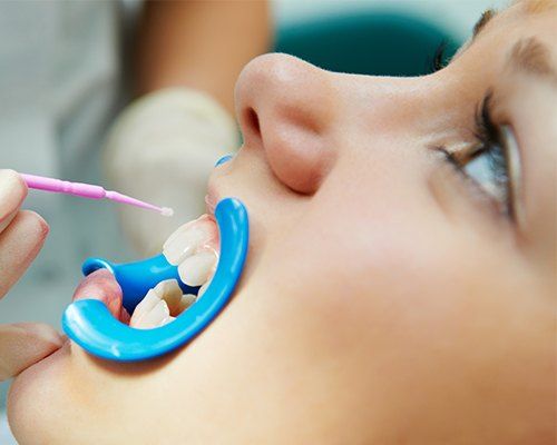 Child receiving fluoride treatment