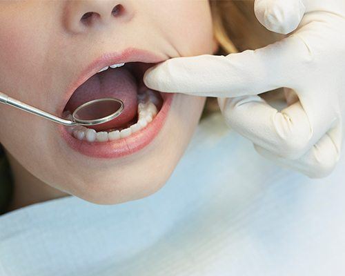 Closeup of smile during dental treatment