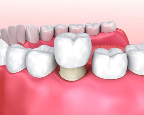 model of dental crown