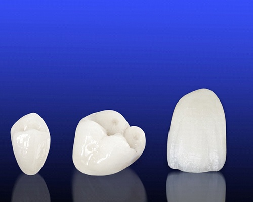 all-ceramic restorations