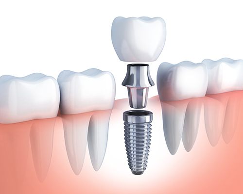 Animation of implant supported dental crown