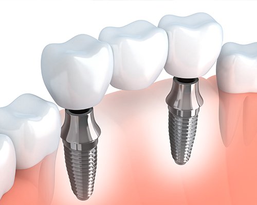 Animation of implant supported fixed bridge