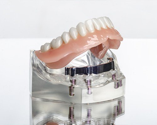 Model implant supported denture
