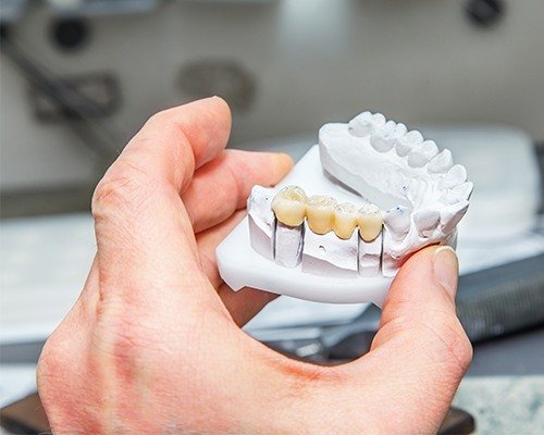 Model smile with fixed bridge restoration