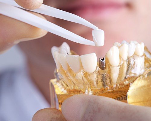 Model smile with implant supported dental crown