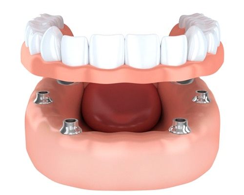 implant-retained dentures 