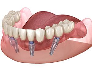 Implant denture graphic on white background