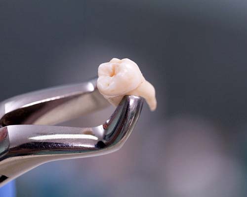 Tooth held in forceps after tooth extraction in Center