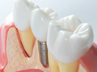 model of a dental implant replacing a tooth