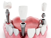 model showing each part of a dental implant