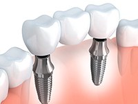 A 3D illustration of an implant bridge