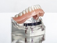 An implant denture placed in a model jaw