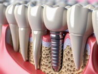 a digital illustration of a dental implant fused with the jawbone