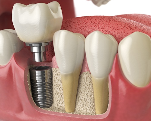 Animation of dental implant placement