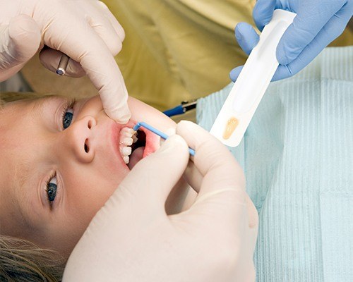 Child receiving fluoride treatment