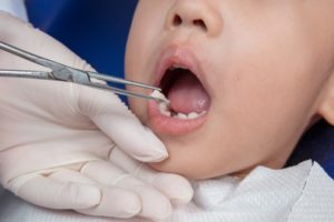Child at dentist for tooth extraction