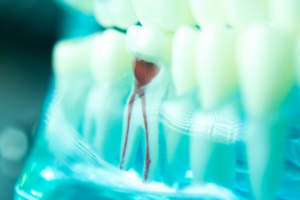 Close up of a dental root inside of a plastic model of teeth