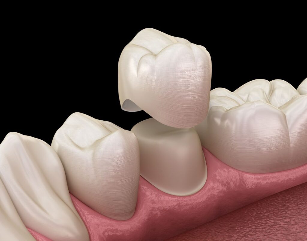 A computer illustration of a dental crown